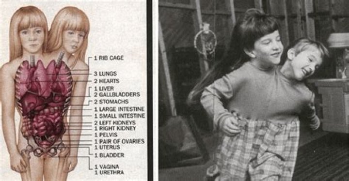 Unraveling The Mystery: Are Abby And Brittany Dead?